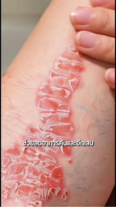 #kembaogiamngua #daviêm #phatbangngứa #eczema #benhngụadà #dabongtróc #calamine #SumifunCalamine #dieutrida‑nhạycảm #giamđỏ‑sưng #văndedà #kembaogiamngụadà